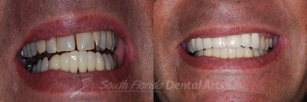dental-bridges1.jpg