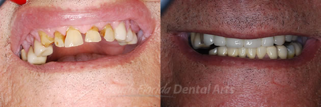 dental-bridges2.jpg