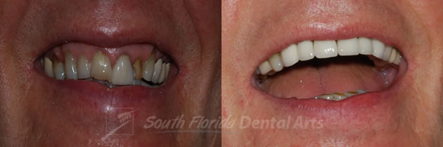 dental-bridges3.jpg