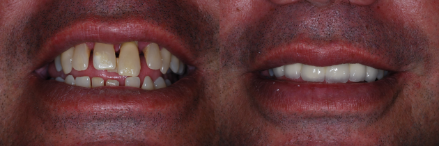 dental-implants1.png