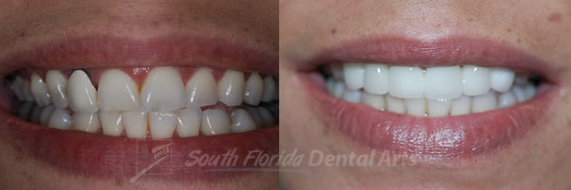 porcelain-veneers1.jpg