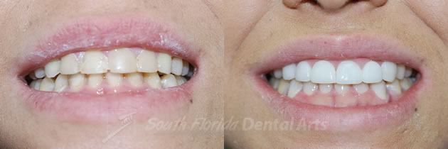 porcelain-veneers2.jpg