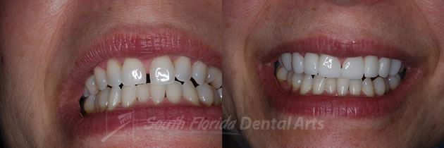 porcelain-veneers3.jpg